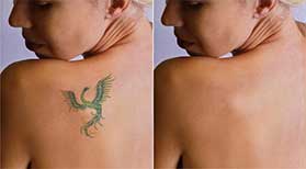 Tattoo Removal Raleigh, NC