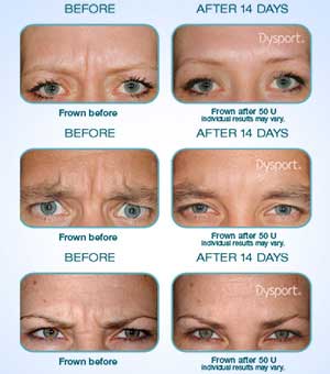Dysport Treatment in Forest City, FL 