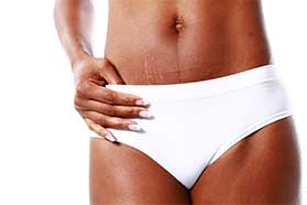 PRP for Stretch Marks Encino, CA