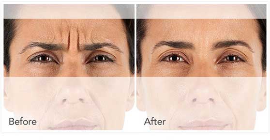 XEOMIN Injection Results in Montclair, NJ