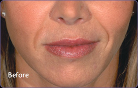 Female Restylane Before Results