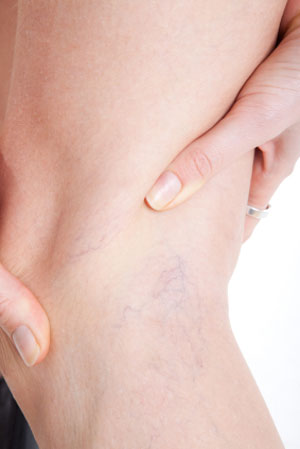 Varicose Vein Treatment in Rutherford, NJ